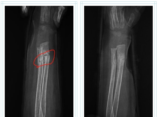 ＂青岛海诺生物工程有限公司＂10岁小孩腿疼是什么原因引起的,10岁小孩腿疼是什么原因引起的怎么治疗